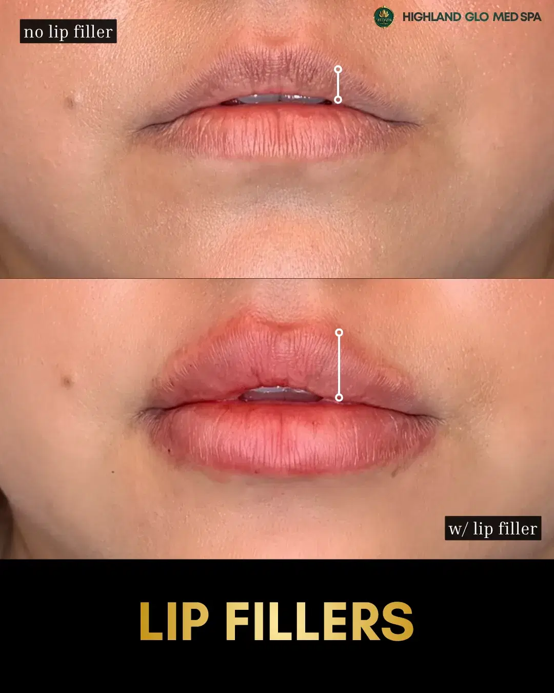 Before and after dermal fillers with Lip Filler at Highland Glo Med Spa