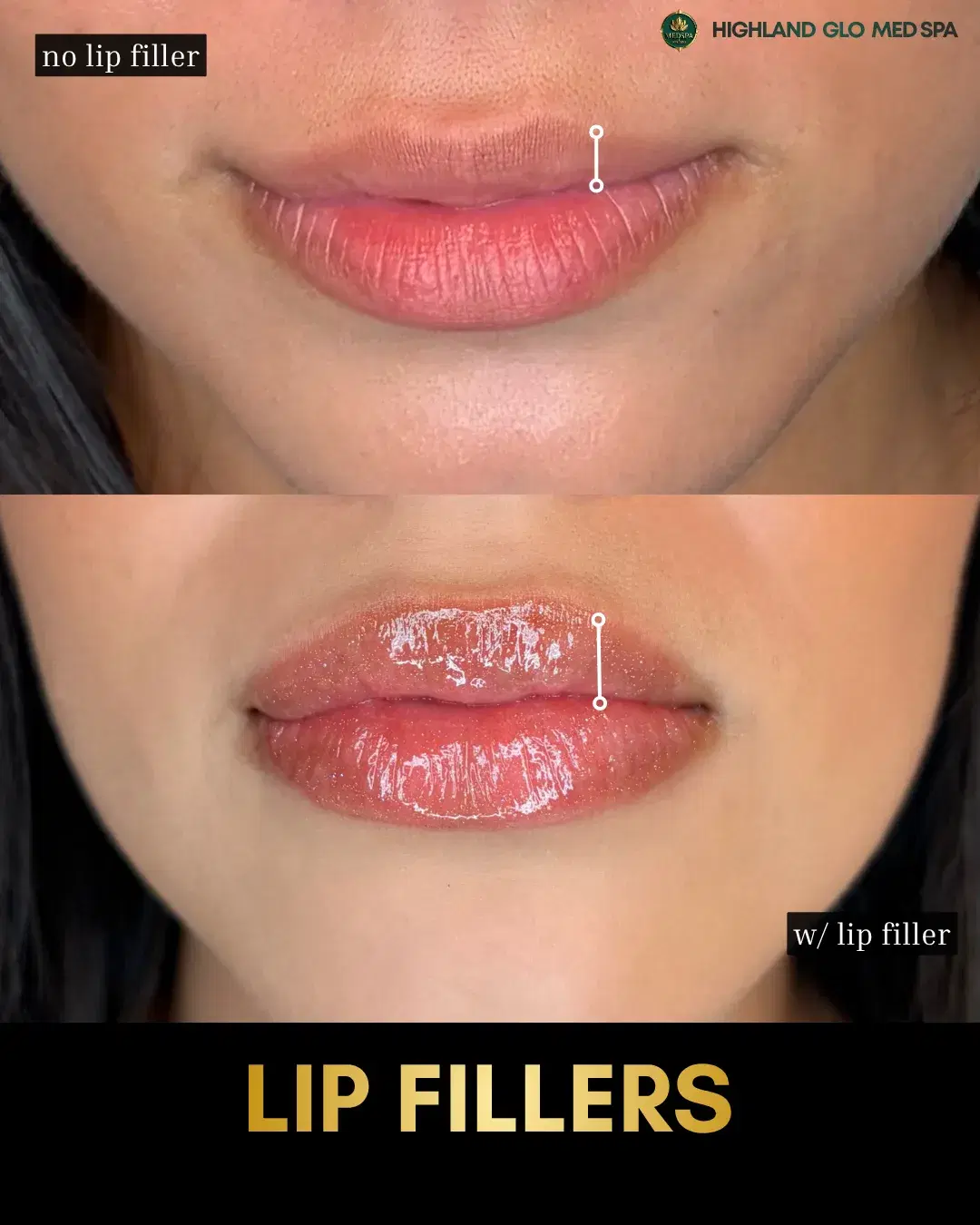 Before and after dermal fillers with Lip Filler at Highland Glo Med Spa