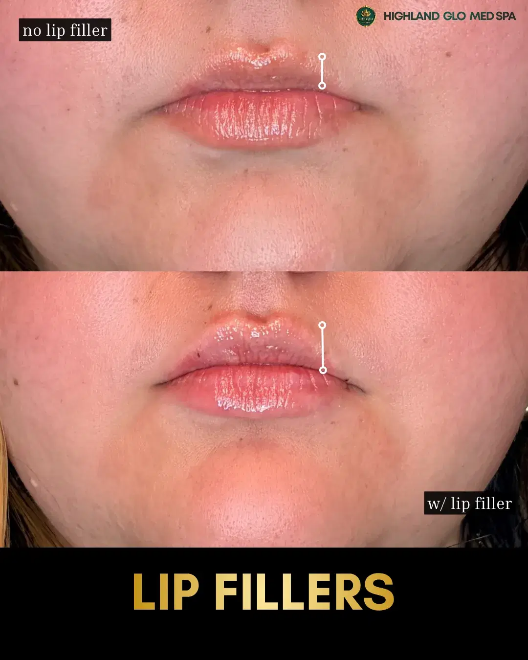 Before and after dermal fillers with Lip Filler at Highland Glo Med Spa