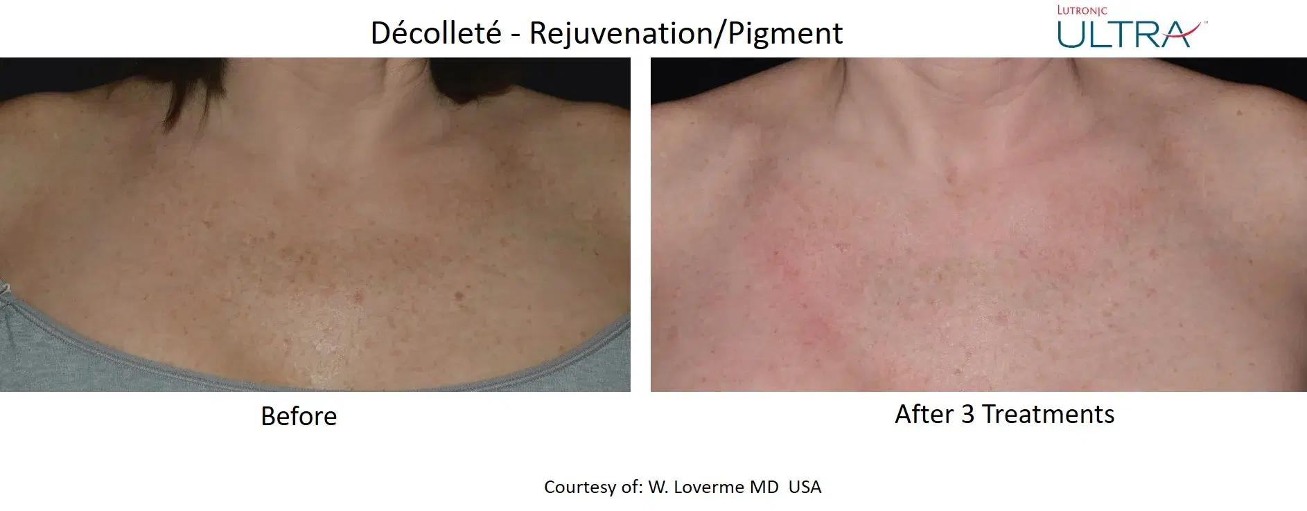 Before and after skin rejuvenation treatment at Highland Glo Med Spa