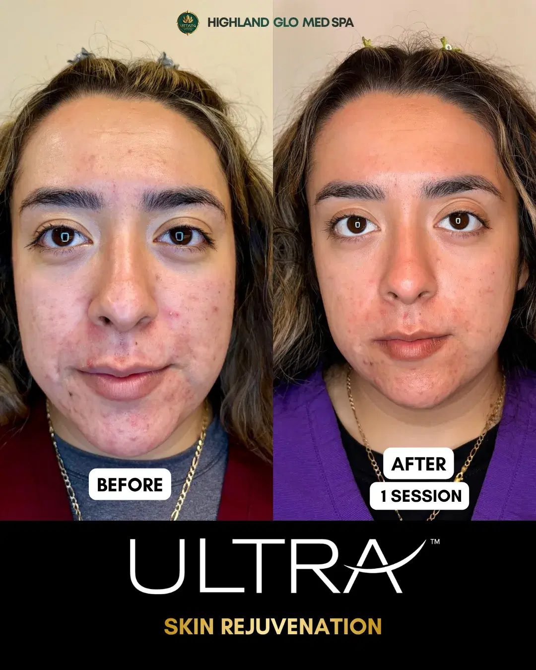 Before and after skin rejuvenation with LaseMD Ultra at Highland Glo Med Spa