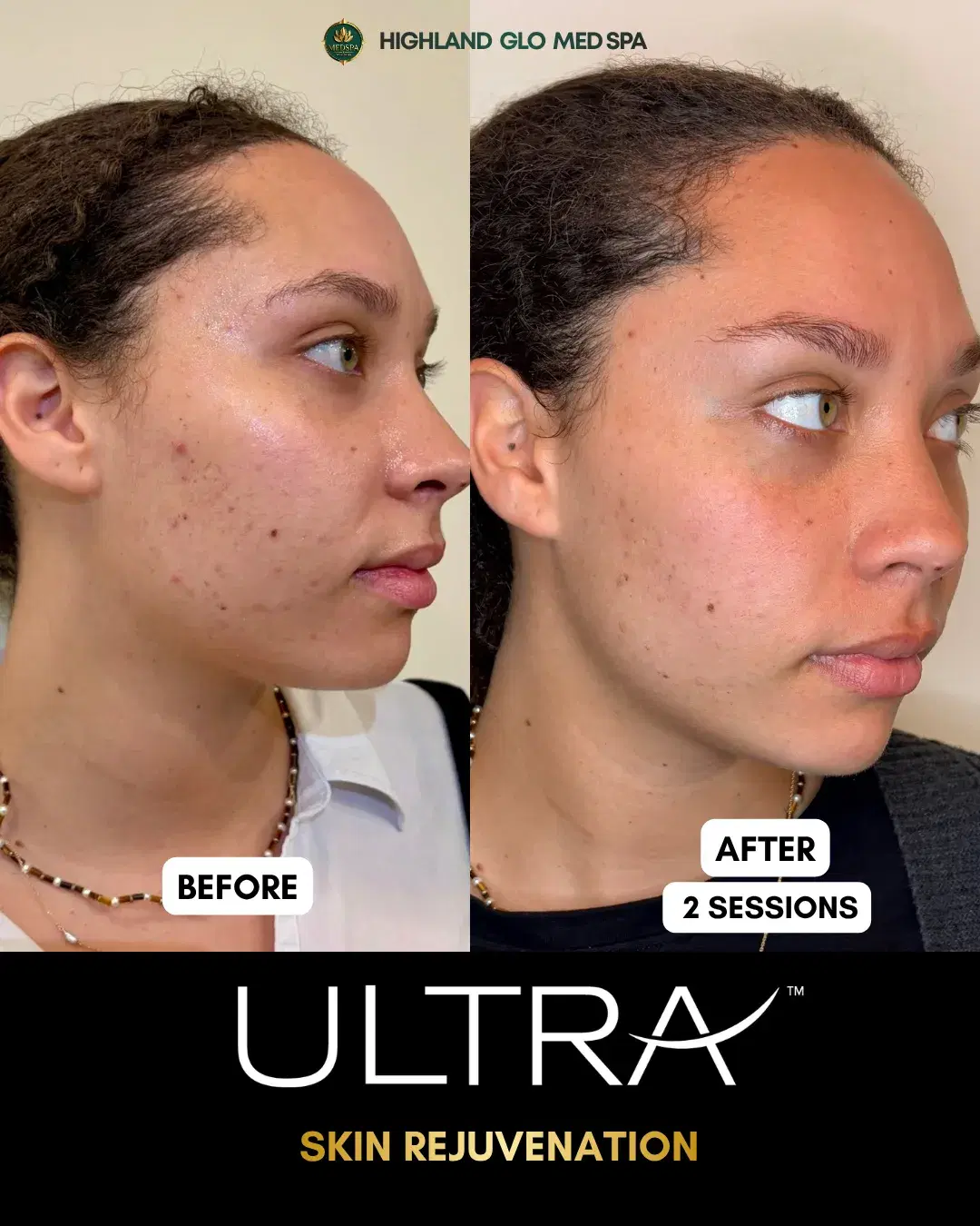 Before and after skin rejuvenation with LaseMD Ultra at Highland Glo Med Spa