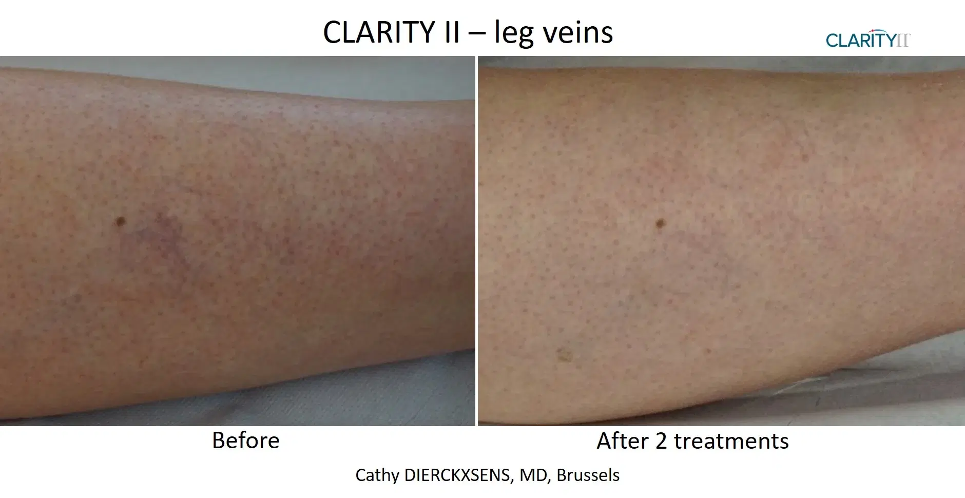 Before and after vein removal treatment at Highland Glo Med Spa